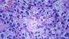 RCC Adjuvant Therapy: Calculating Value RCC Adjuvant Therapy: Calculating Value
