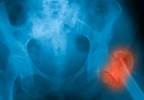 Hip Fracture, Mild Prolonged Hyponatremia Linked Hip Fracture, Mild Prolonged Hyponatremia Linked