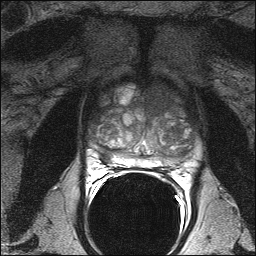 Clinically significant tumors outside of index lesions often missed, study finds. Clinically significant tumors outside of index lesions often missed, study finds.