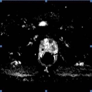 In multiparametric magnetic resonance imaging, rectal distension have a negative effect on T2-weighted and diffusion-weighted images. In multiparametric magnetic resonance imaging, rectal distension have a negative effect on T2-weighted and diffusion-weighted images.