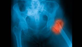 Patients with non-dialysis chronic kidney disease (CKD) may be at elevated risk for hip fracture Patients with non-dialysis chronic kidney disease (CKD) may be at elevated risk for hip fracture