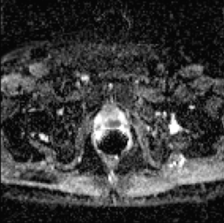 Apalutamide and enzalutamide each prolongs metastasis-free survival in patients with non-metastatic castration-resistant prostate cancer. Apalutamide and enzalutamide each prolongs metastasis-free survival in patients with non-metastatic castration-resistant prostate cancer.