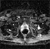 FDA Oks Drug for Non-metastatic Castration-Resistant Prostate Cancer FDA Oks Drug for Non-metastatic Castration-Resistant Prostate Cancer