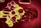 PCSK9 Linked to New-Onset Diabetes After Kidney Transplantation PCSK9 Linked to New-Onset Diabetes After Kidney Transplantation