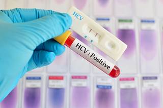 HCV infection increases ESRD risk among patients with diabetes. HCV infection increases ESRD risk among patients with diabetes.
