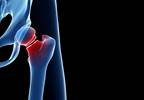 Fracture Risk Factors in Transplant Patients ID'd Fracture Risk Factors in Transplant Patients ID'd