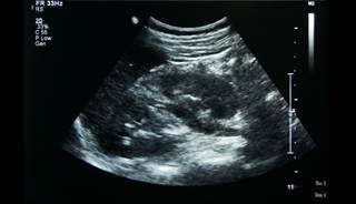 The presence of VUR is linked to an increased risk of UTI and renal scarring. The presence of VUR is linked to an increased risk of UTI and renal scarring.