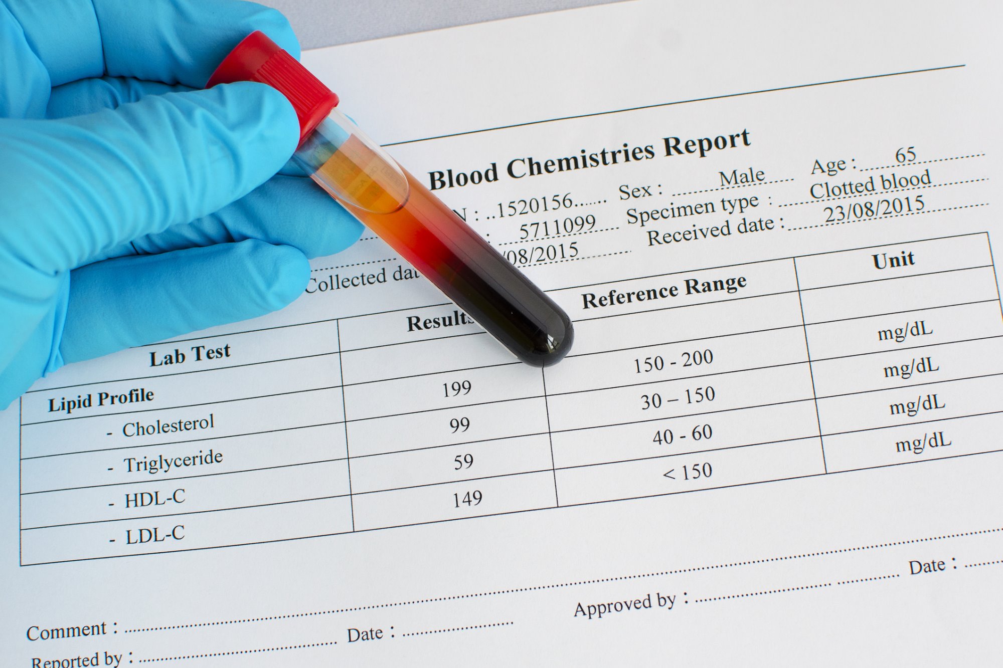 High Grade Prostate Cancer Risk Again Linked To