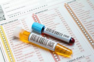 In a pilot study, metabolomic analyses of serum and urine showed a high level of predictive ability. In a pilot study, metabolomic analyses of serum and urine showed a high level of predictive ability.