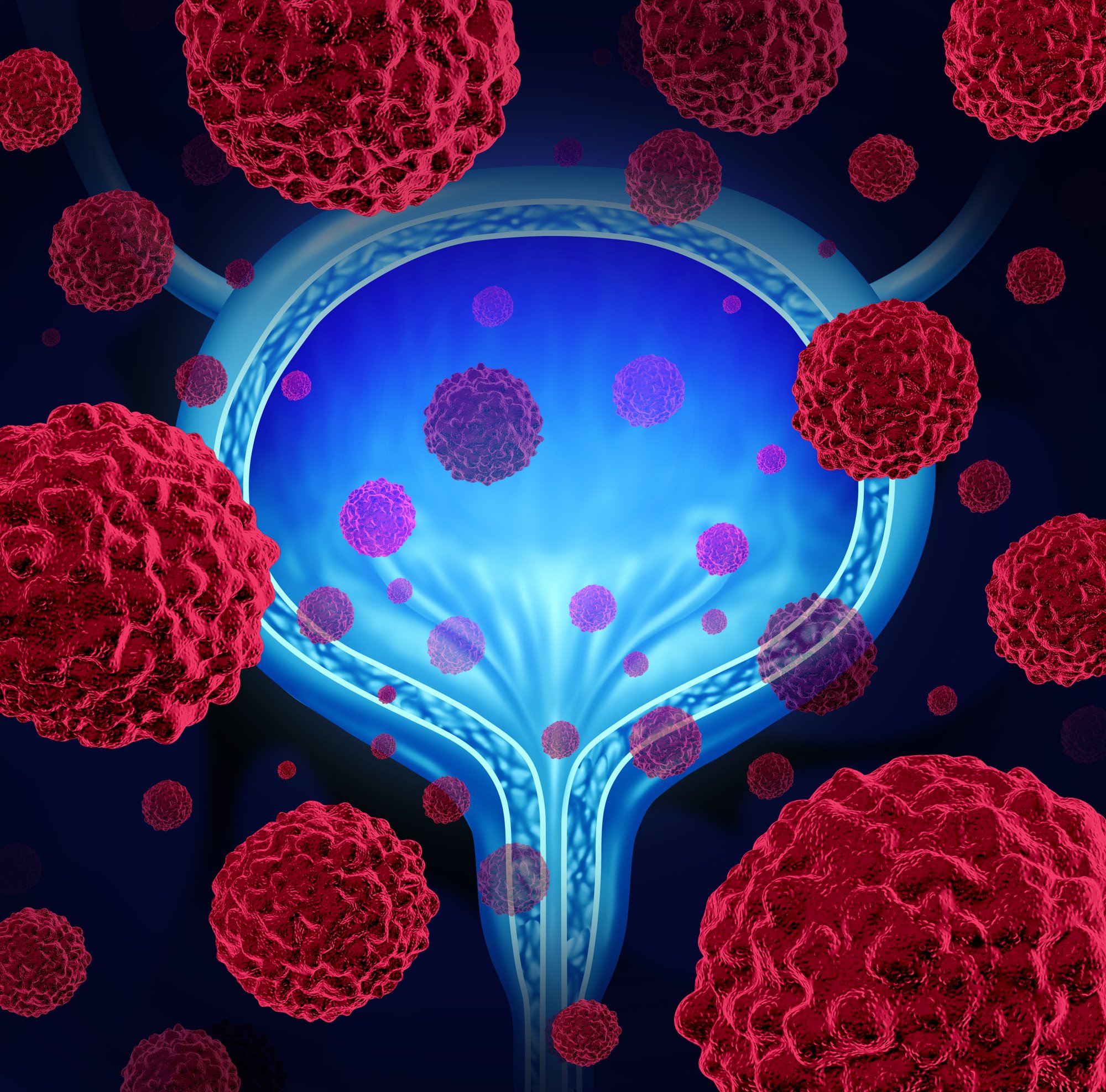 Blue Light Cystoscopy Increases Bladder Cancer Detection Rate - Renal