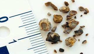Studies also link kidney stone development to osteoporosis and proton pump inhibitor use. Studies also link kidney stone development to osteoporosis and proton pump inhibitor use.