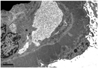 Targeted IL-6 Inhibition With Sirukumab Ineffective in Lupus Nephritis Targeted IL-6 Inhibition With Sirukumab Ineffective in Lupus Nephritis
