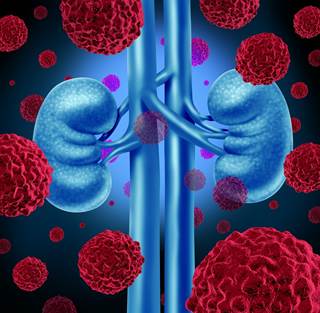 Among patients with clear-cell renal-cell carcinoma at high risk for tumor recurrence, the duration of disease-free survival was significantly longer in the sunitinib group. Among patients with clear-cell renal-cell carcinoma at high risk for tumor recurrence, the duration of disease-free survival was significantly longer in the sunitinib group.