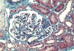 Novel Drug Shows Promise for FSGS Novel Drug Shows Promise for FSGS