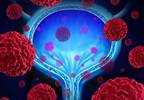 Global Demand for Bladder Cancer Treatment Threatens Supply in 2019 Global Demand for Bladder Cancer Treatment Threatens Supply in 2019
