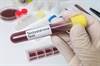 Higher Testosterone Levels May Hike Renal Stone Risk Higher Testosterone Levels May Hike Renal Stone Risk