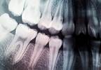 T2DM Microvascular Complications Linked to Periodontitis Severity T2DM Microvascular Complications Linked to Periodontitis Severity