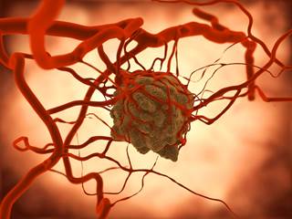 Extent of disease and change in PSA were the strongest predictors of disease progression in men with chemotherapy-naïve mCRPC treated with abiraterone. Extent of disease and change in PSA were the strongest predictors of disease progression in men with chemotherapy-naïve mCRPC treated with abiraterone.