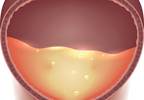 OAB Symptoms Eased With Intravesical Botulinum Toxin OAB Symptoms Eased With Intravesical Botulinum Toxin
