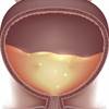 OAB Symptoms Eased With Intravesical Botulinum Toxin OAB Symptoms Eased With Intravesical Botulinum Toxin