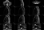 MRI Differentiates Low-Grade Bladder Tumors MRI Differentiates Low-Grade Bladder Tumors
