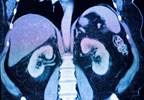 AKI Risks Not Up With SGLT2 Inhibitors AKI Risks Not Up With SGLT2 Inhibitors