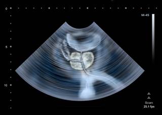 Fusion biopsy has improved over the last decade and increasingly detects clinically significant prostate cancer, according to data trends from one institution. Fusion biopsy has improved over the last decade and increasingly detects clinically significant prostate cancer, according to data trends from one institution.