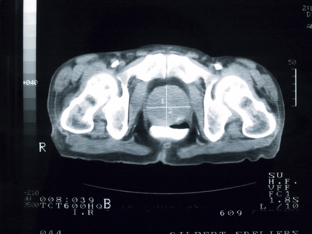 Mri Predicts Outcomes Of Prostate Cancer Salvage Radiotherapy Renal And Urology News 8075