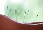 Acupuncture Effective for Stress Incontinence Acupuncture Effective for Stress Incontinence