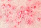 Herpes Zoster May Increase Risk of Myocardial Infarction, Stroke Herpes Zoster May Increase Risk of Myocardial Infarction, Stroke