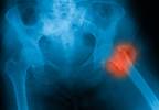 One-Third of Canadian Patients Get Hip Fracture Repair Within 24 Hours One-Third of Canadian Patients Get Hip Fracture Repair Within 24 Hours