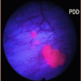 Enhanced Cystoscopy Improves the Care of Bladder Cancer Patients Enhanced Cystoscopy Improves the Care of Bladder Cancer Patients
