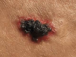 The findings showed that only 29.1% of the skin cancers started in moles patients already had. The findings showed that only 29.1% of the skin cancers started in moles patients already had.