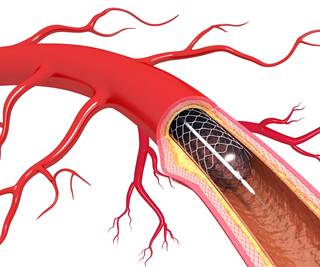 Among patients with short-term peripherally inserted central catheter, about 1 in 10 has a complication Among patients with short-term peripherally inserted central catheter, about 1 in 10 has a complication