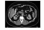 New Study Supports Recent AUA Guidelines for Small Renal Masses New Study Supports Recent AUA Guidelines for Small Renal Masses