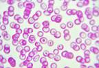 Anemia Risk Factors in Diabetic Nephropathy Patients Identified Anemia Risk Factors in Diabetic Nephropathy Patients Identified
