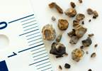 Higher Relative Urine Supersaturations Up Stone Risk Higher Relative Urine Supersaturations Up Stone Risk