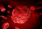 Pharmacomechanical Thrombolysis Does Not Cut Post-thrombotic Syndrome Pharmacomechanical Thrombolysis Does Not Cut Post-thrombotic Syndrome