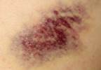 Calciphylaxis in CKD Patients Linked to Hypercoagulable Conditions Calciphylaxis in CKD Patients Linked to Hypercoagulable Conditions