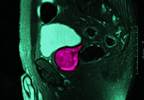 MRI Scans Can Avert Many Prostate Biopsies MRI Scans Can Avert Many Prostate Biopsies