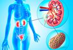 ESRD Linked to Recurrent Symptomatic Kidney Stones ESRD Linked to Recurrent Symptomatic Kidney Stones
