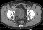 Lymphoceles: A Contemporary Review and an Approach for Prevention Lymphoceles: A Contemporary Review and an Approach for Prevention