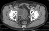 Lymphoceles: A Contemporary Review and an Approach for Prevention Lymphoceles: A Contemporary Review and an Approach for Prevention