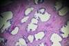 Prostate Cancer Risk After Single Negative Biopsy Quantified Prostate Cancer Risk After Single Negative Biopsy Quantified