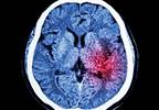 Urgency Urinary Incontinence Linked to Previous Stroke Urgency Urinary Incontinence Linked to Previous Stroke