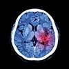 Urgency Urinary Incontinence Linked to Previous Stroke Urgency Urinary Incontinence Linked to Previous Stroke