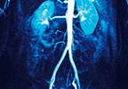 Outpatient AKI Is a Risk Factor for Death, Adverse Renal Outcomes Outpatient AKI Is a Risk Factor for Death, Adverse Renal Outcomes