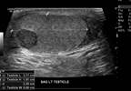 Spermatogenesis Still Occurs in Men With Testicular Cancer Spermatogenesis Still Occurs in Men With Testicular Cancer