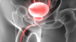 Lowering nocturnal urine production and enabling patients to void consistently at capacity may ease nocturia in men with low bladder capacity. Lowering nocturnal urine production and enabling patients to void consistently at capacity may ease nocturia in men with low bladder capacity.