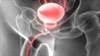 Simple Measures May Help Men With Low Bladder Capacity and Nocturia Simple Measures May Help Men With Low Bladder Capacity and Nocturia